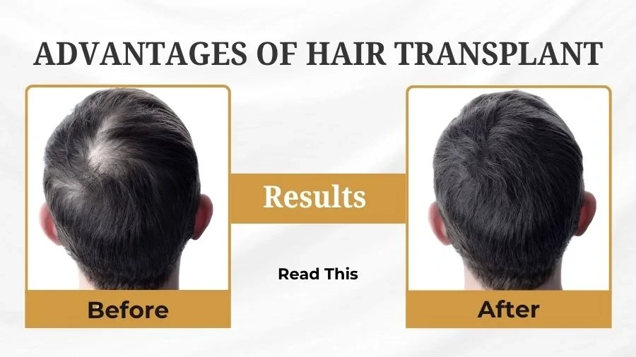 6 Advantages of Hair Transplant