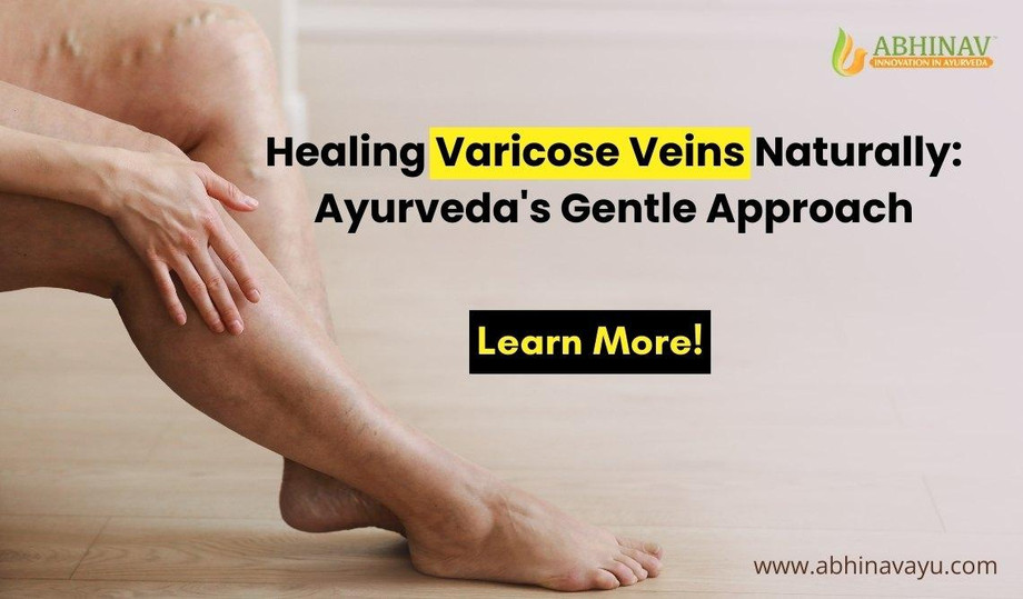 Ayurvedic Medicine for Varicose Veins