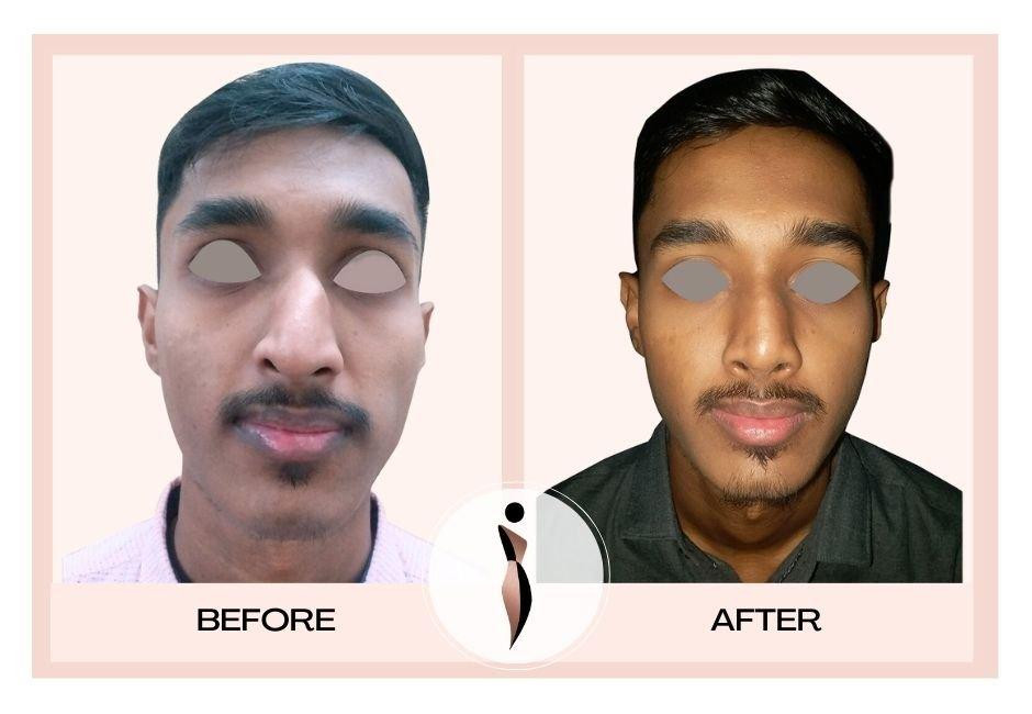 Best Rhinoplasty Surgeon in Mumbai — Dr. Amiti Shah Doctor Near Me Best Rhinoplasty Surgeon in Mumbai