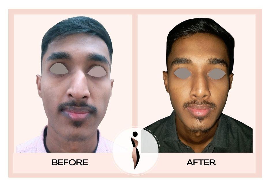 Best Rhinoplasty Surgeon in India
