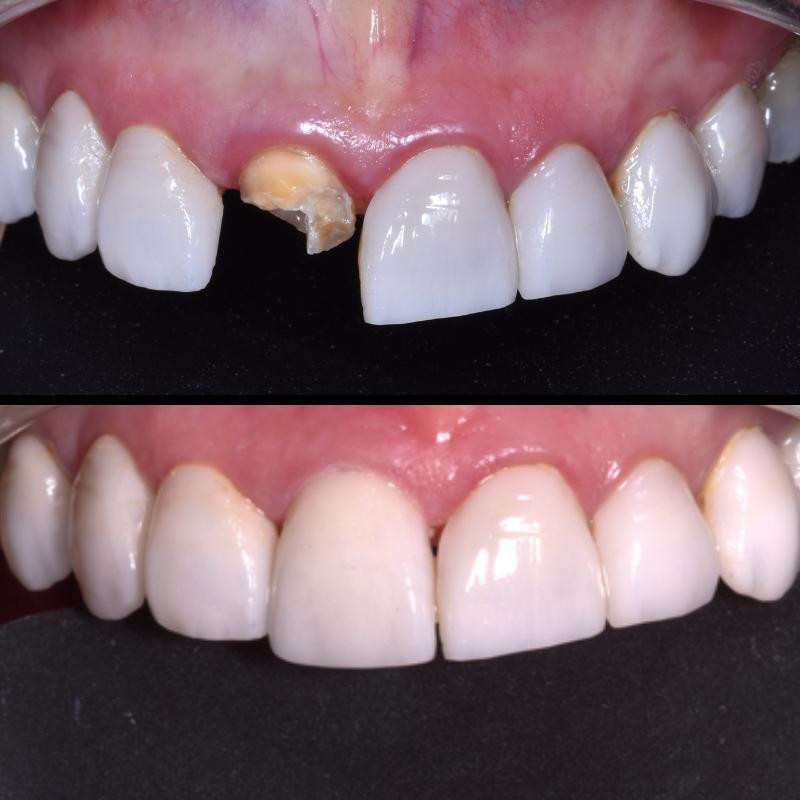 Dental Bridges and dental Crowns – Smiledesignincolombia