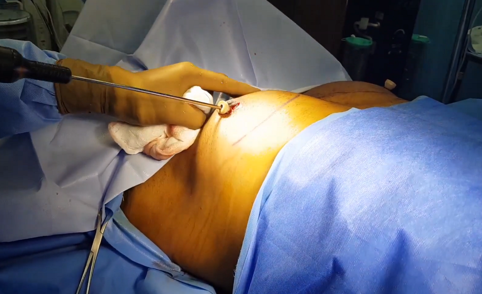 Gynecomastia surgery in Mumbai