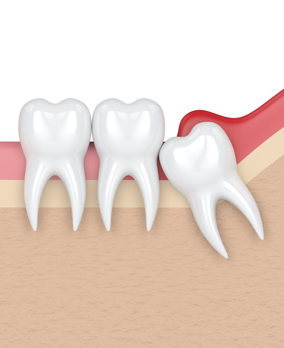 wisdomtooth1.jpg