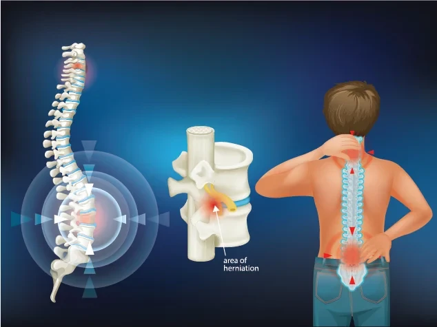 spinepain.webp