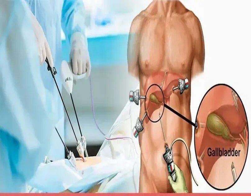 laparoscopiccholecystectomy.jpg