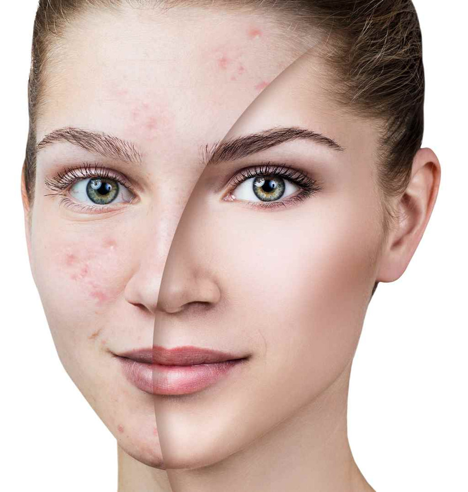 bestwaytotreatacne_718540468.jpg