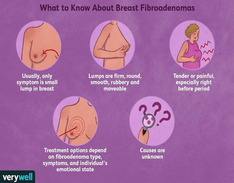 breastfibroadenomatreatments4300199ac75ed1f27c4bffa551937bea5cbf9d1.jpg