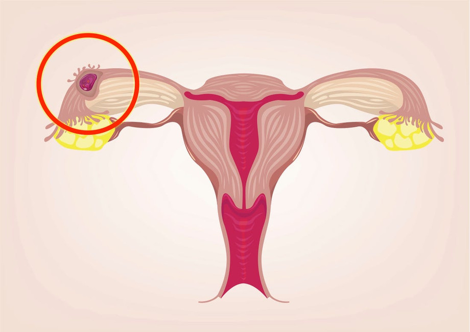 ectopicpregnancy.jpeg