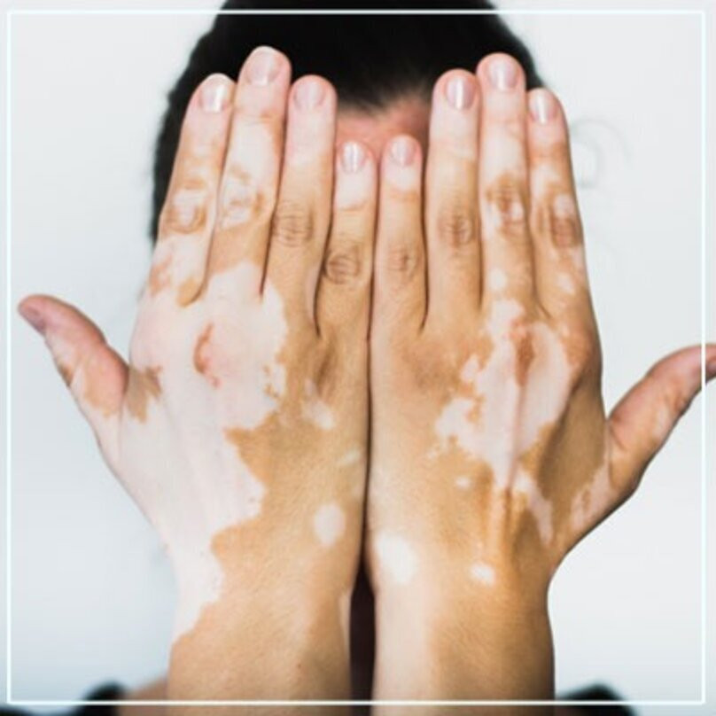 vitiligo1.jpg