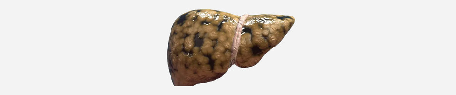 fattyliver3.jpg