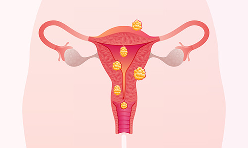 uterinefibroid1.jpg