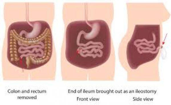 ileostomy600x369.jpg