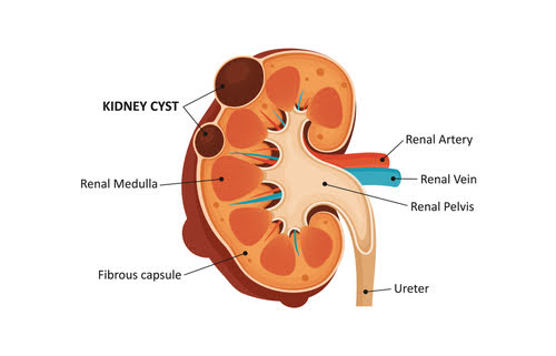 kidneycyst.jpg