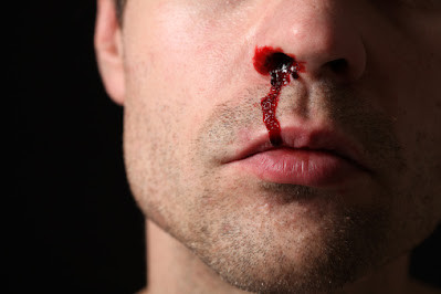 whatisnosebleed.jpg