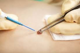 electrosurgerymarket5.jpg