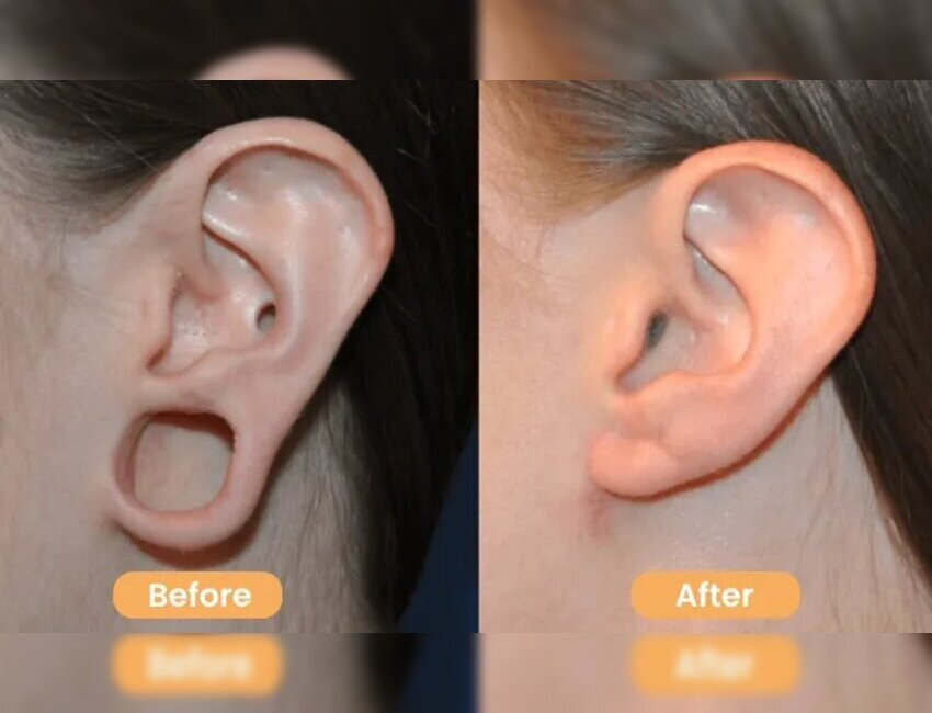earloberepair.jpg