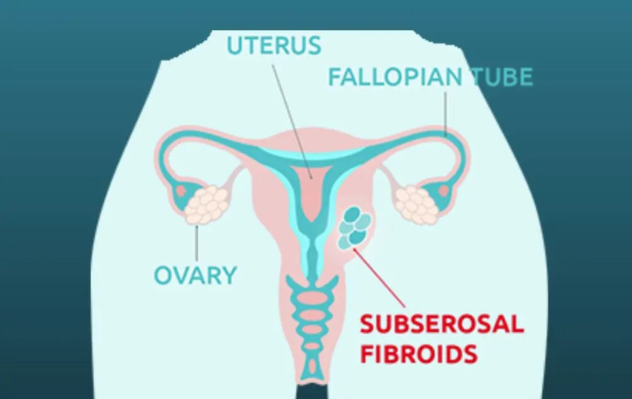 subserosalfibroids.jpg