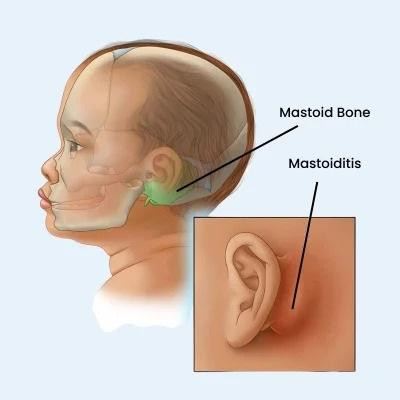 mastoiditis.jpg