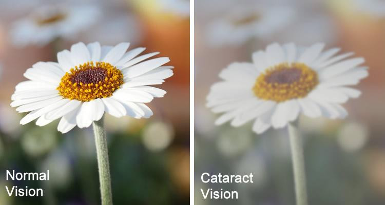 cataractsurgerybeforeandaftervision.jpg