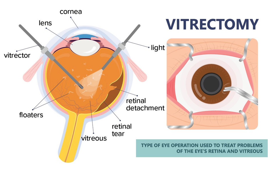 detachedretinasurgery1356x892.jfif
