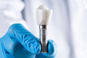 bestdentalimplantinbhilai.jpg
