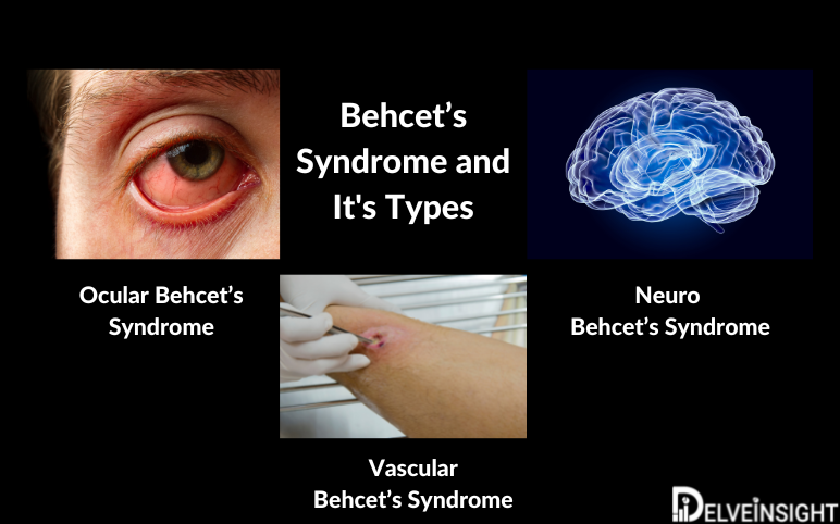 behcetssyndrometreatmentmarket.png