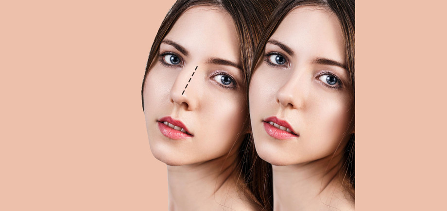 rhinoplastynosejob1.jpg