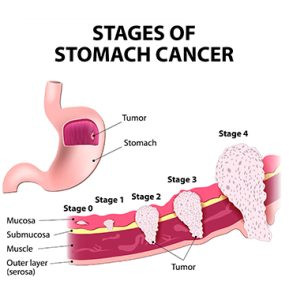 stagesofstomachcancer289x300.jpg