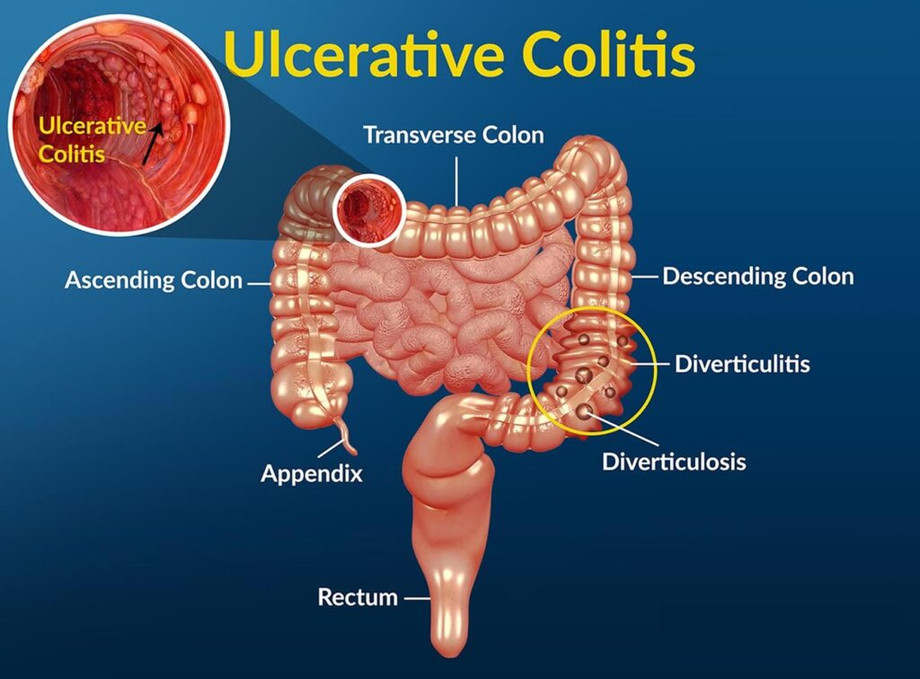 ulcerativecollitis1024x756.jpg