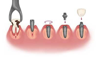 dentalimplantsclinicinrameshnagardelhi.jpg