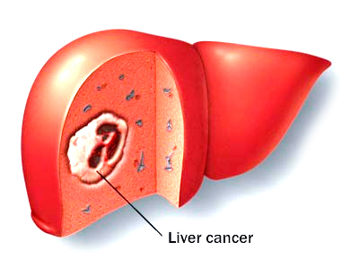 thecausesoflivercancer.png