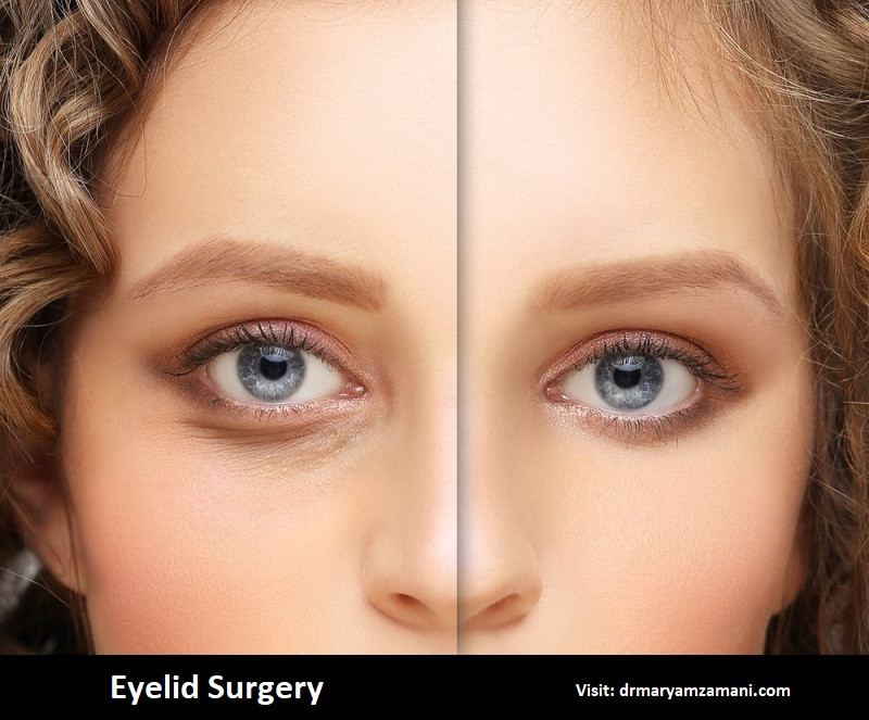 eyelidsurgery.jfif