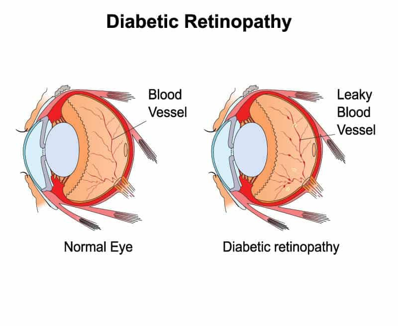 diabeticretinopathy1.jpg