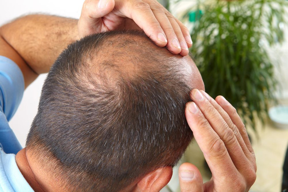 whataretherisksandpotentialcomplicationsofhairtransplantation.jpg