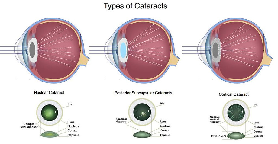 cataractstypes1.jpg