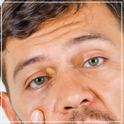 xanthelasma.jpg