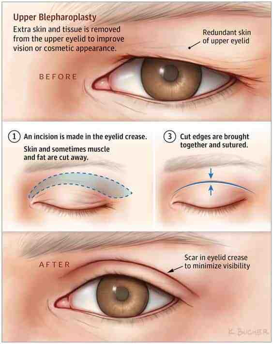 blepharoplastyinmumbaiincisions.jpg