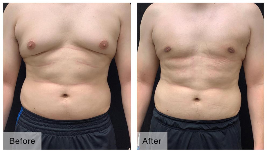 gynecomastia.jpg