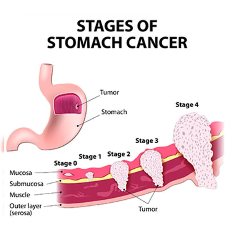 stagesofstomachcancer2.jpg