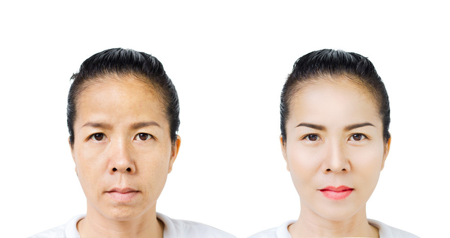browlift2.jpg