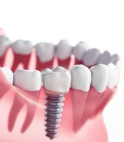 dentalimplants1.jpeg