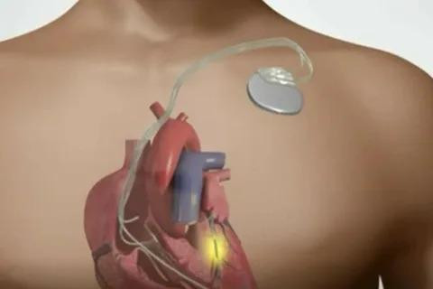 cardiacpacemakermarket.jpg