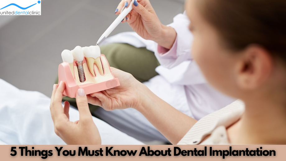 5thingsyoumustknowaboutdentalimplantation.png