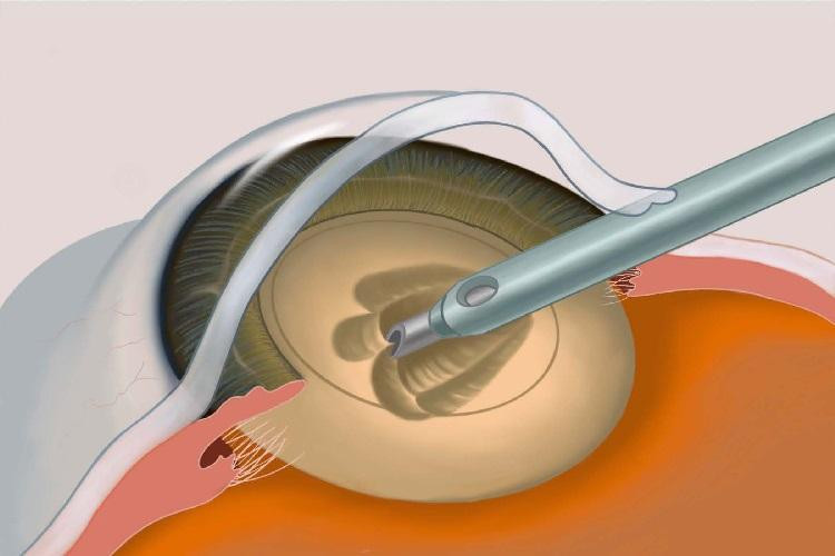 bestlasikeyesurgeryspecialist33024forlasercorrection.jpg