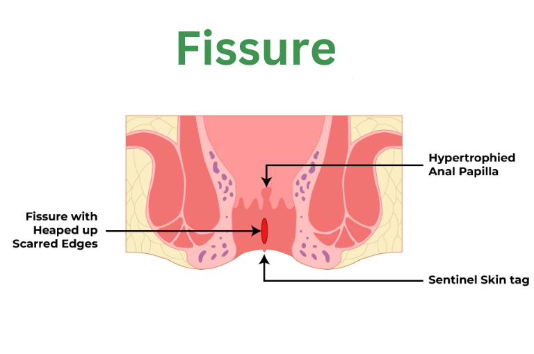 fissure.png