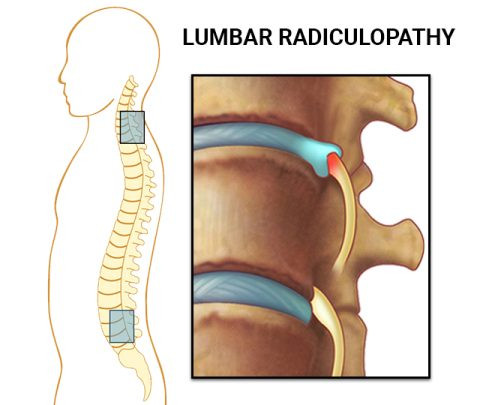 radiculopathy480x405.jpg