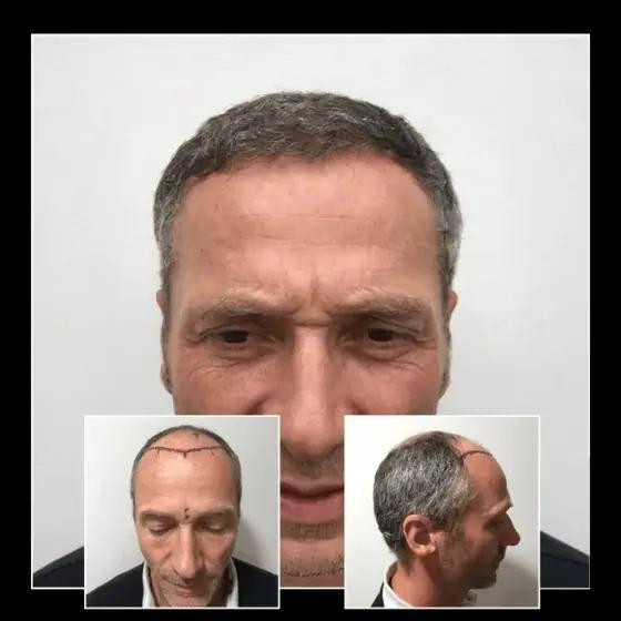 imageye____imgi_18_beforeafterhairtransplantbrentwoodessex041.jpeg