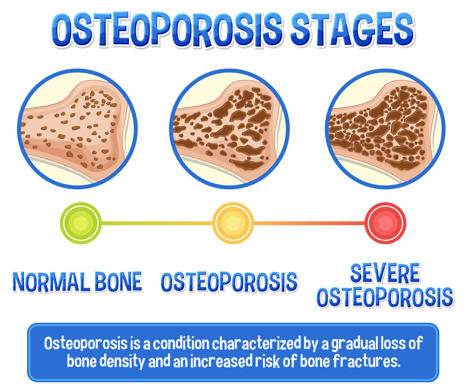 osteoporosis.jpg