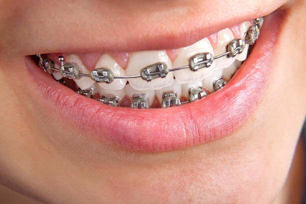 cupertinobraces.jpg
