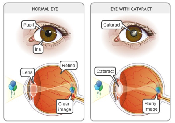 cataract.jpg
